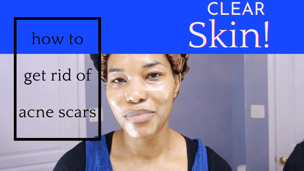 Removing Post-Acne Marks